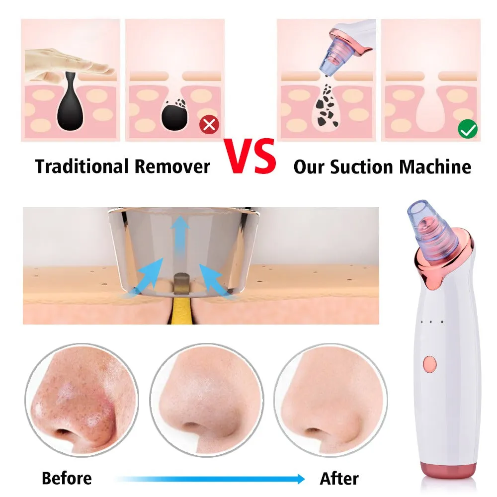 Electric Blackhead & Acne Remover